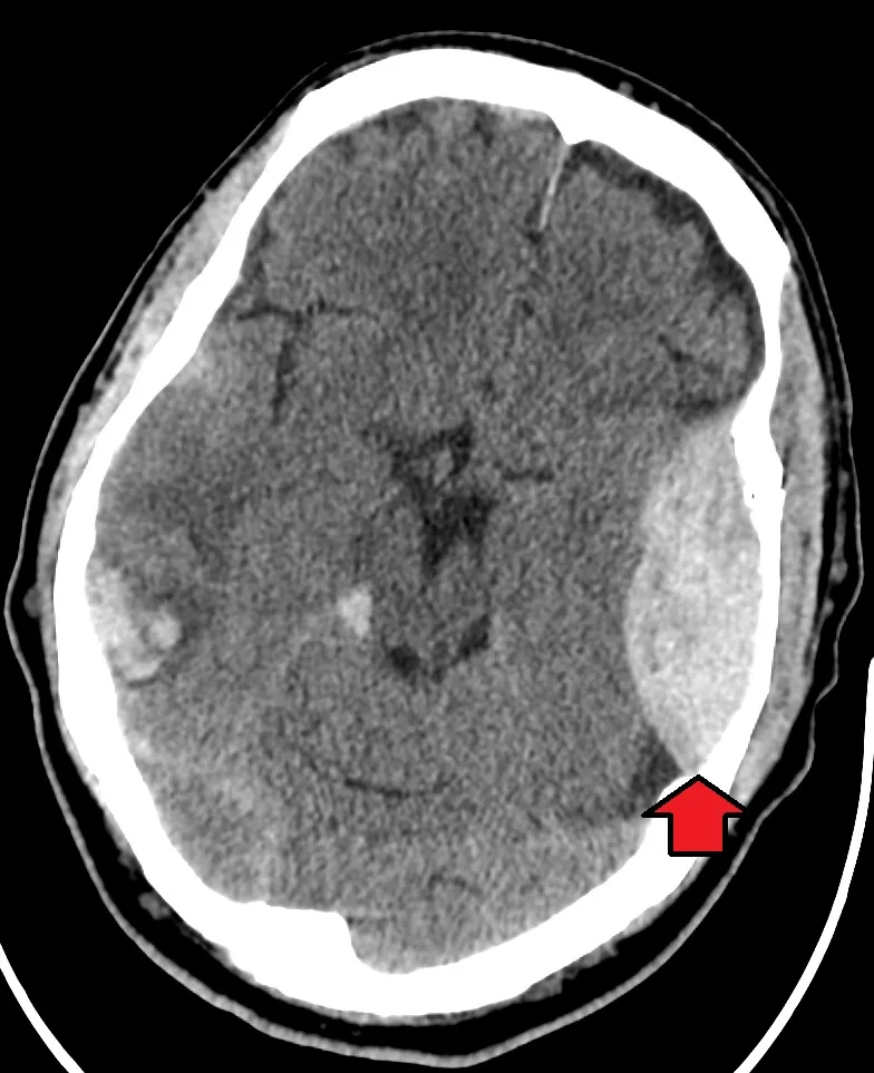 CT scan showing acute subdural hematoma