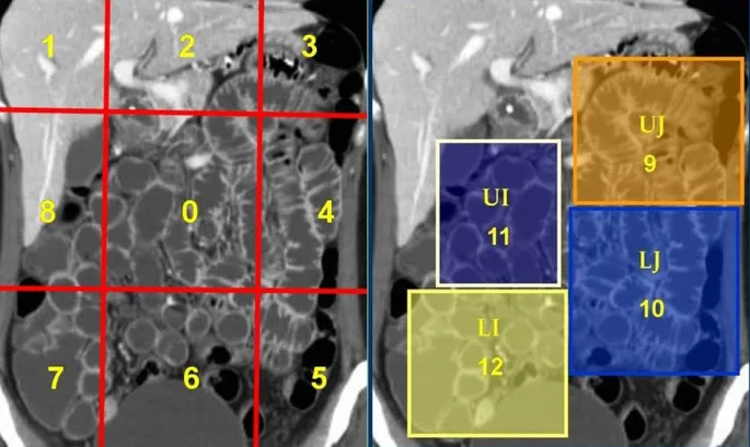Peritoneal Carcinomatosis Index (PCI) regions