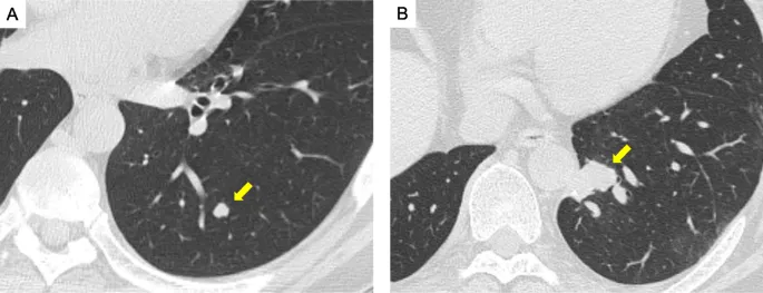 CT chest: Solitary resectable pulmonary metastasis