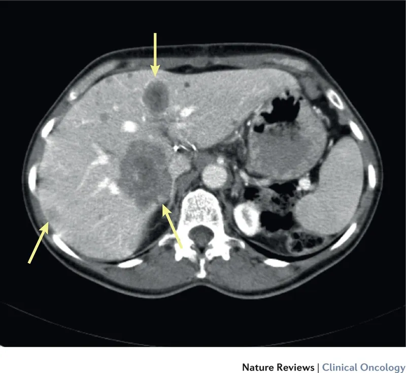 CT scan of liver with colorectal metastasis