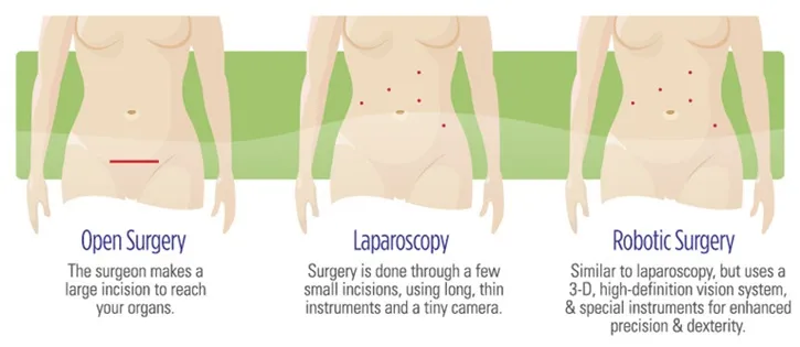 Open, Laparoscopic, and Robotic Surgery Incisions