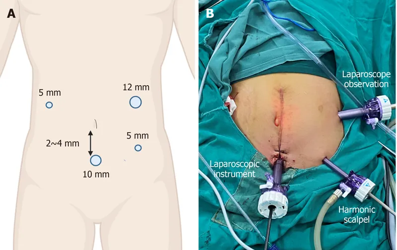 Laparoscopic port placement and surgical setup