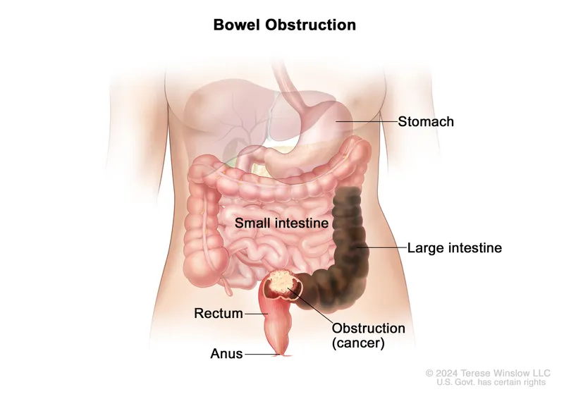 Bowel Obstruction due to Cancer