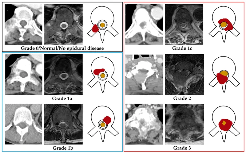 Epidural metastasis grading on axial CT and MRI