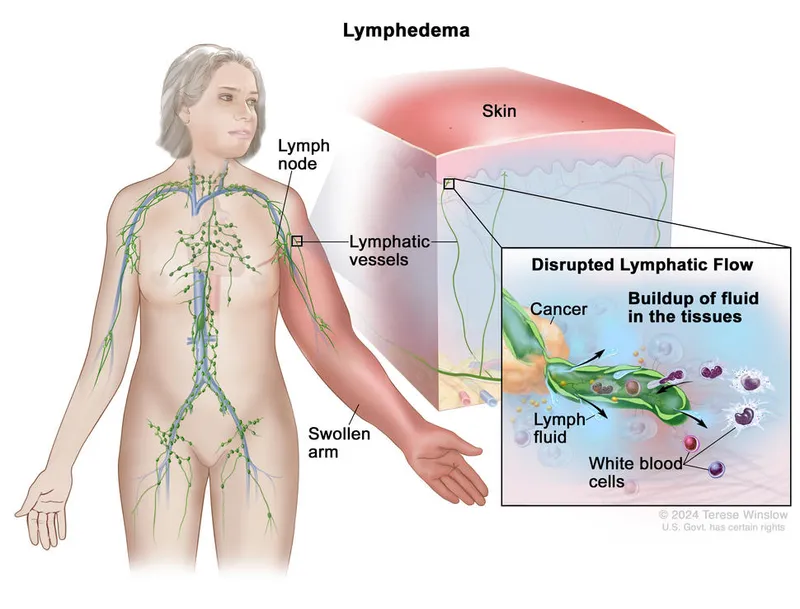Lymphedema after axillary lymph node dissection