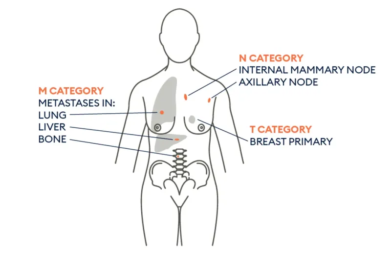 TNM staging components: primary tumor, nodes, metastasis