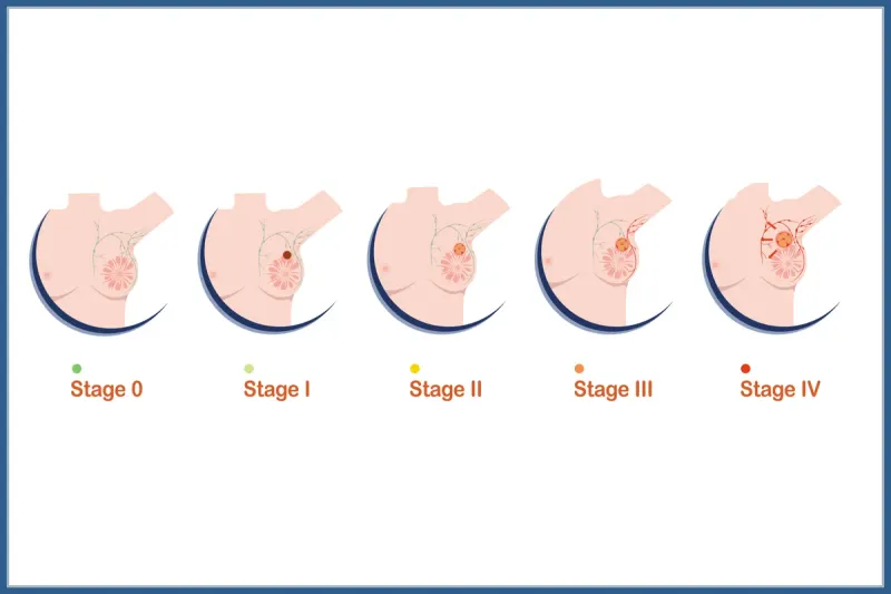 Breast Cancer Staging (Stages 0-IV)