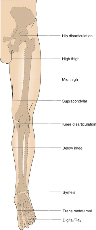 Lower Extremity Amputation Levels