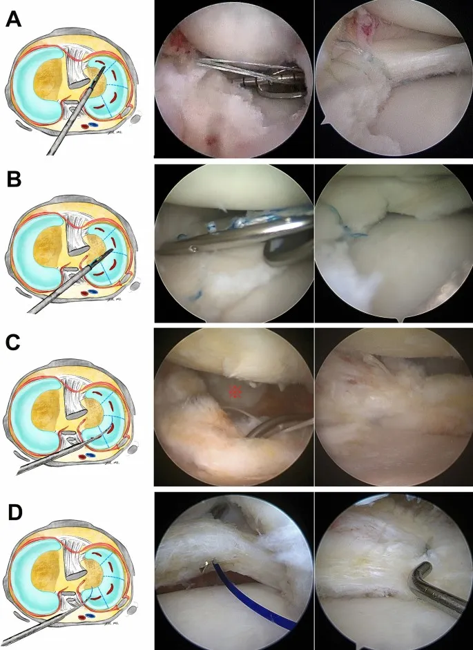 Knee arthroscopy: portals, instruments, and procedures