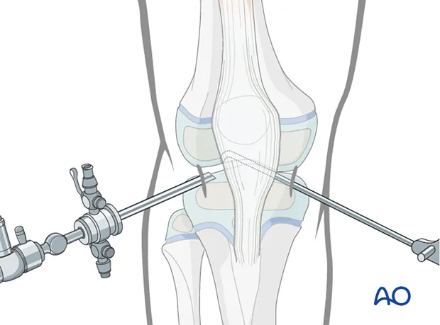 Knee arthroscopy portals and instrument insertion