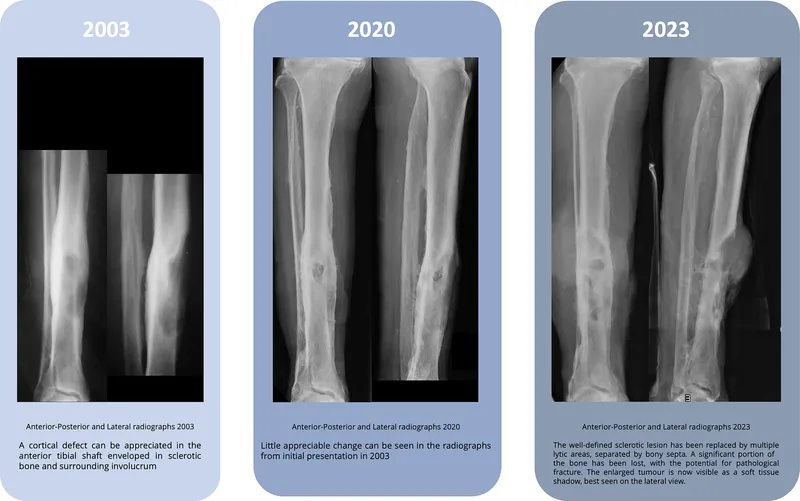 X-ray series: Chronic osteomyelitis with pathologic fracture