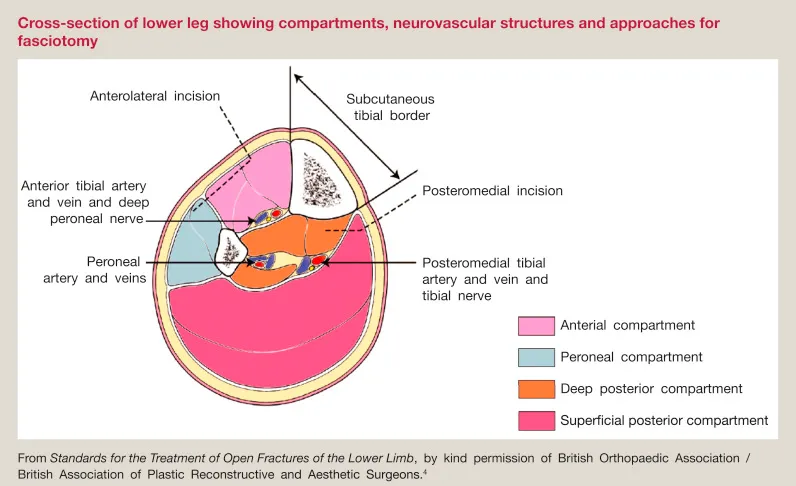 Lower leg compartments, neurovasculature, and fasciotomy