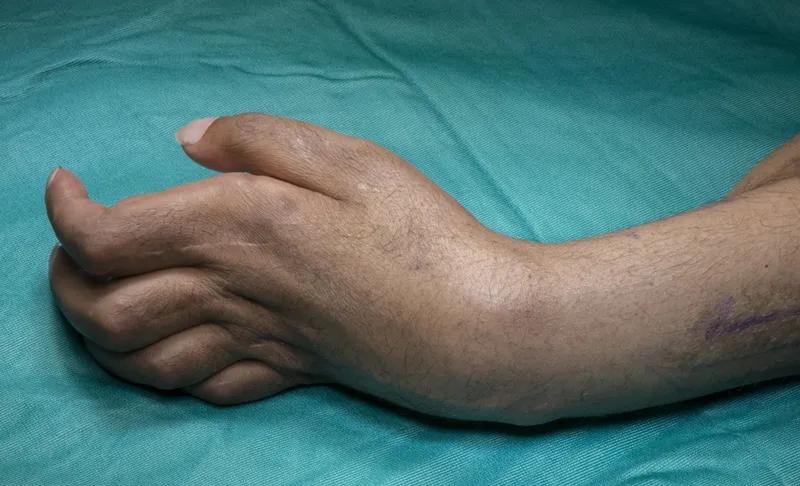 Volkmann’s ischemic contracture of the hand