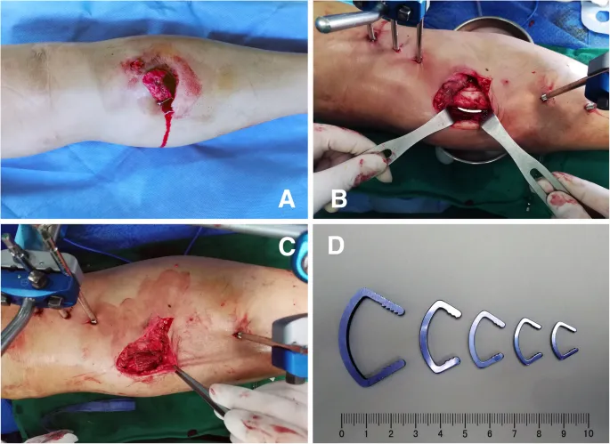 External fixator application for open tibia fracture