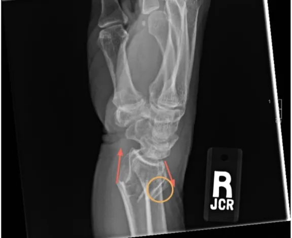 Distal radius fracture with displacement and angulation