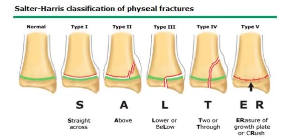 Salter-Harris fracture classification with SALTER mnemonic