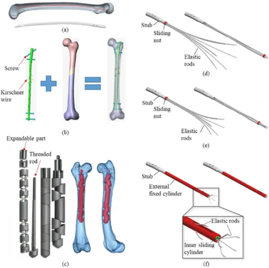 Internal Fixation Methods: Screws, Wires, and Rods