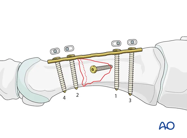 Internal fixation of bone fracture with plate and screws
