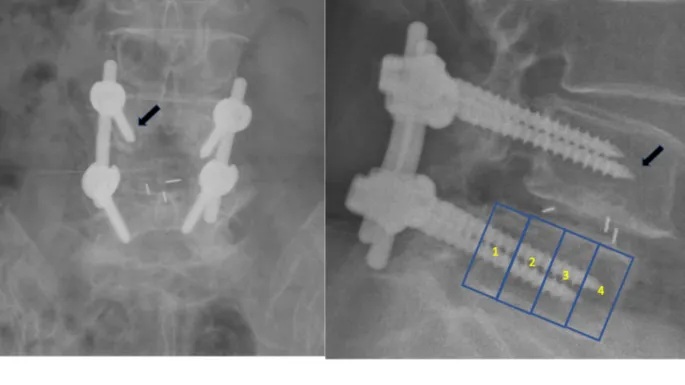 X-ray: Radiolucent lines around orthopedic screw