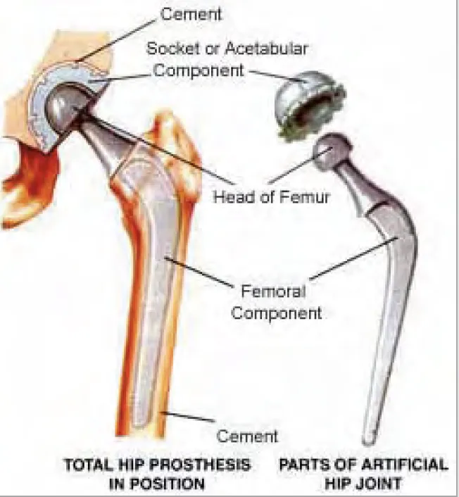 Total Hip Arthroplasty Components and Placement