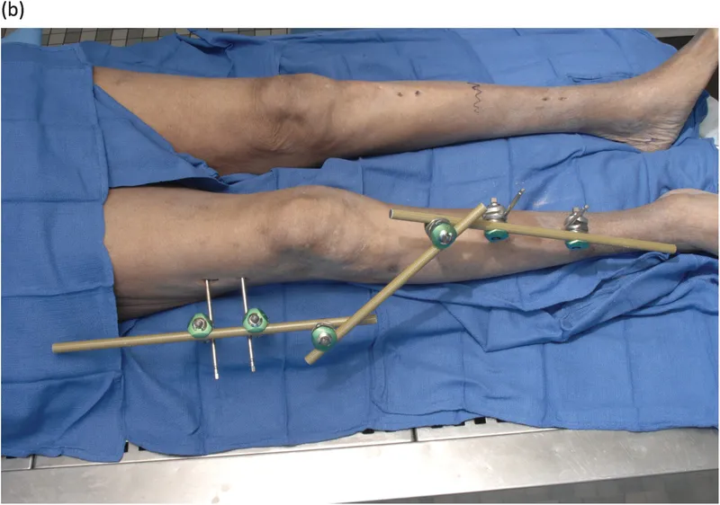 External fixator for damage control orthopedics