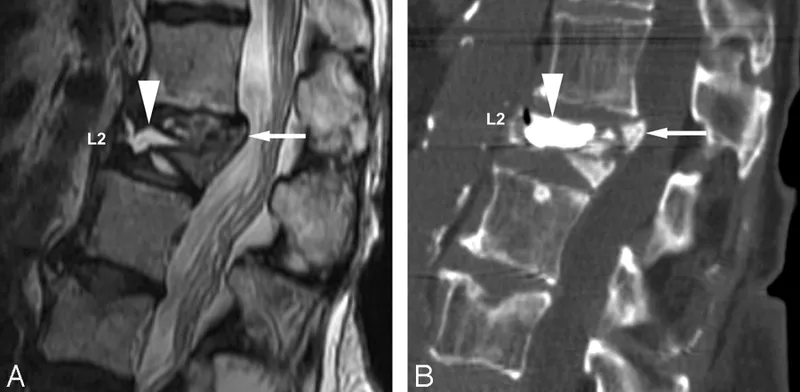 Sagittal MRI and CT of L2 burst fracture with retropulsion