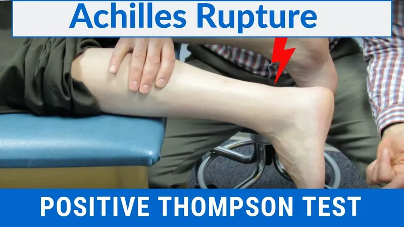 Positive Thompson Test for Achilles Tendon Rupture