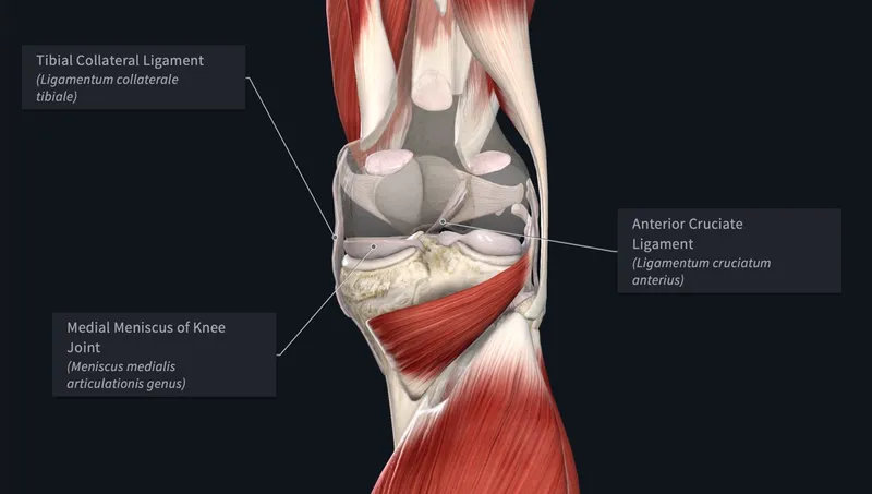 Knee unhappy triad injury: ACL, MCL, and medial meniscus