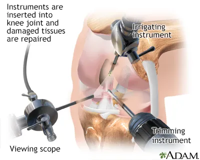Knee Arthroscopy: Instruments and Procedure