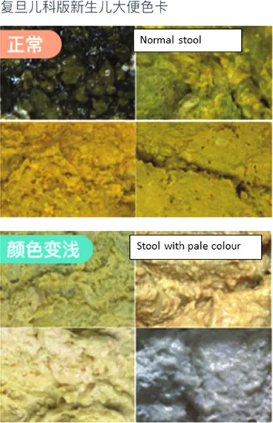 Infant Stool Color Chart: Normal vs. Acholic Stools