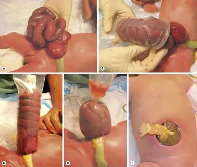 Gastroschisis silo placement and reduction