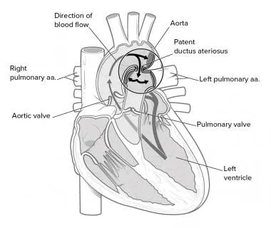 Patent Ductus Arteriosus (PDA) blood flow diagram