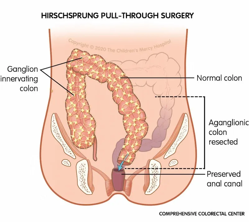 Hirschsprung Pull-Through Surgery Diagram