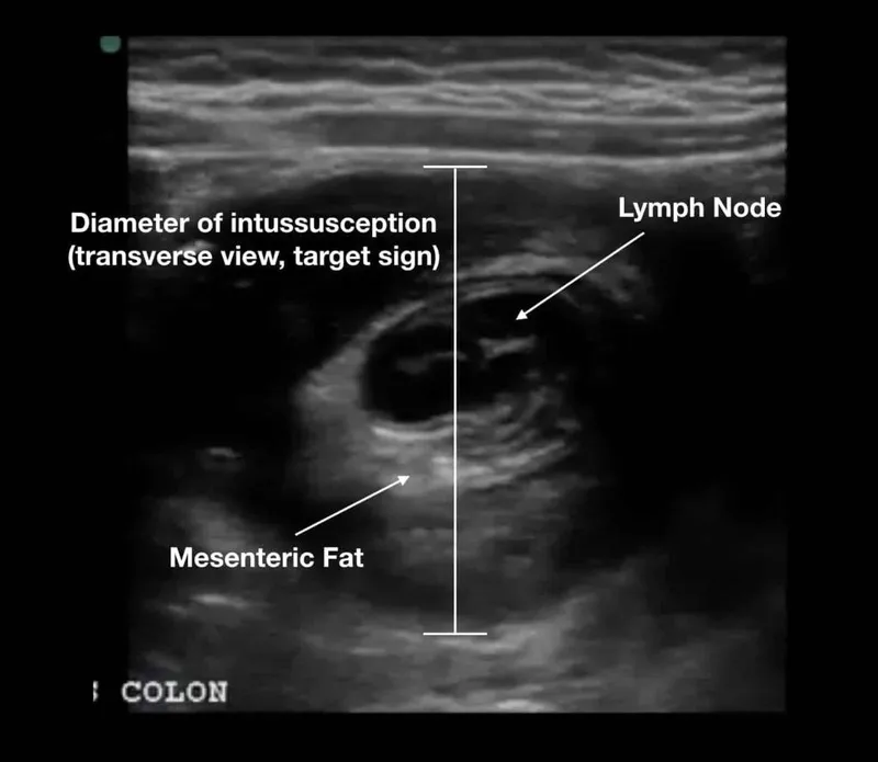 Ultrasound: Intussusception Target Sign