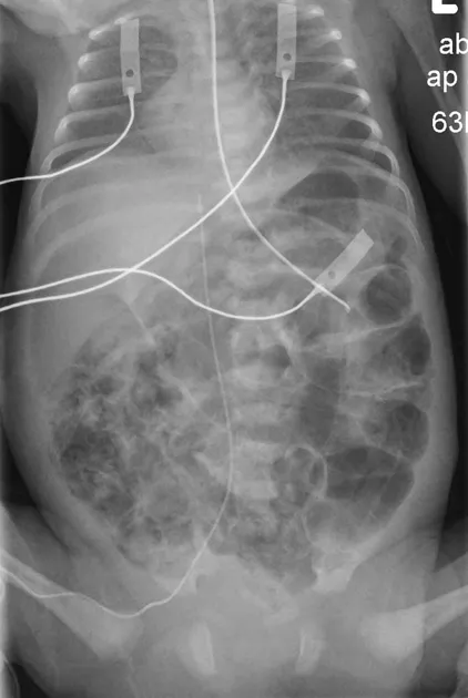 Abdominal X-ray: Neonate with NEC and pneumoperitoneum