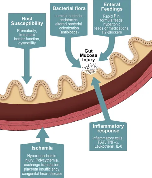 Necrotizing Enterocolitis Pathophysiology