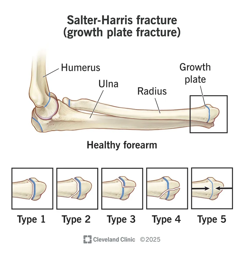 Salter-Harris Classification of Physeal Fractures