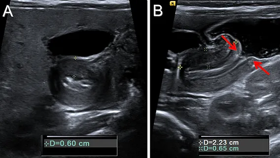 Pyloric Stenosis Ultrasound: Target Sign & Measurements