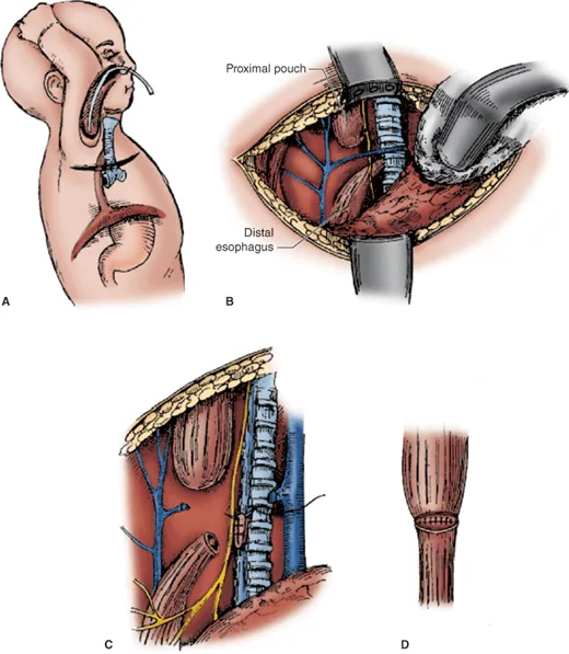 Tracheoesophageal fistula repair with thoracotomy