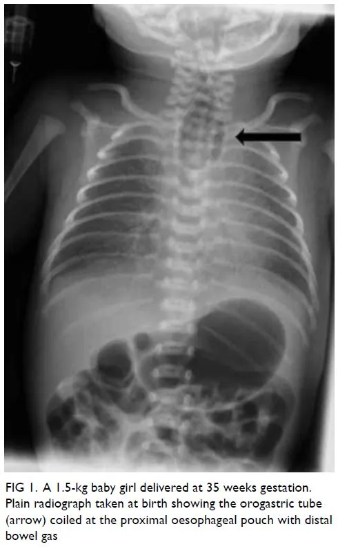 X-ray: Tracheoesophageal fistula with coiled NG tube