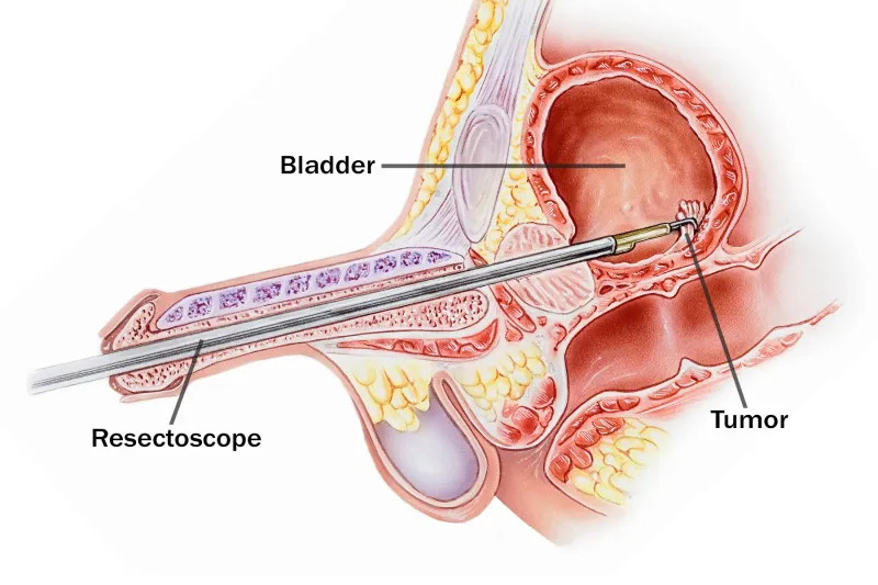 TURBT procedure for bladder tumor removal
