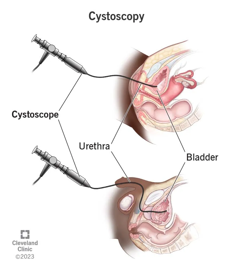 Cystoscopy: Male and Female Urethra & Bladder Anatomy