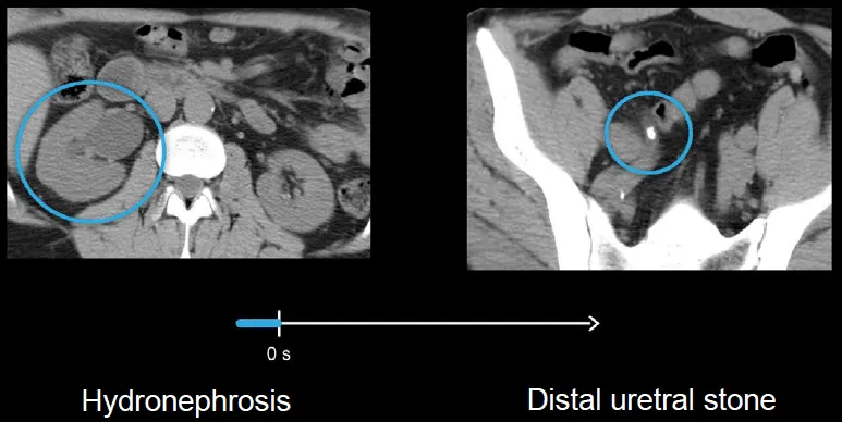 CT showing hydronephrosis and distal ureteral stone