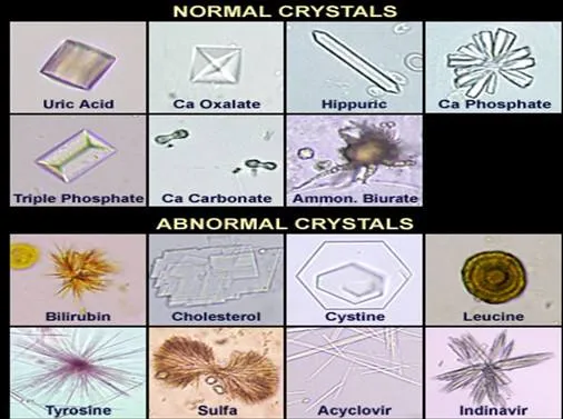 Urine microscopy of normal and abnormal crystals