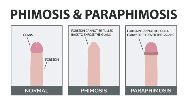 Phimosis and Paraphimosis: Normal vs. Abnormal Foreskin