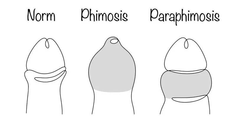 Phimosis and Paraphimosis Comparison Diagram