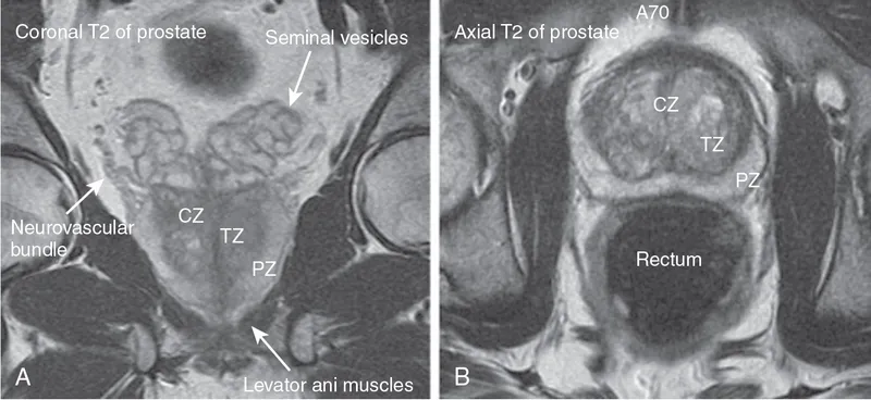 Prostate MRI: Coronal & Axial Views with Anatomy