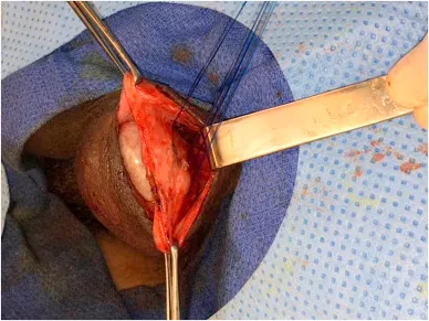 Surgical orchiopexy for testicular torsion