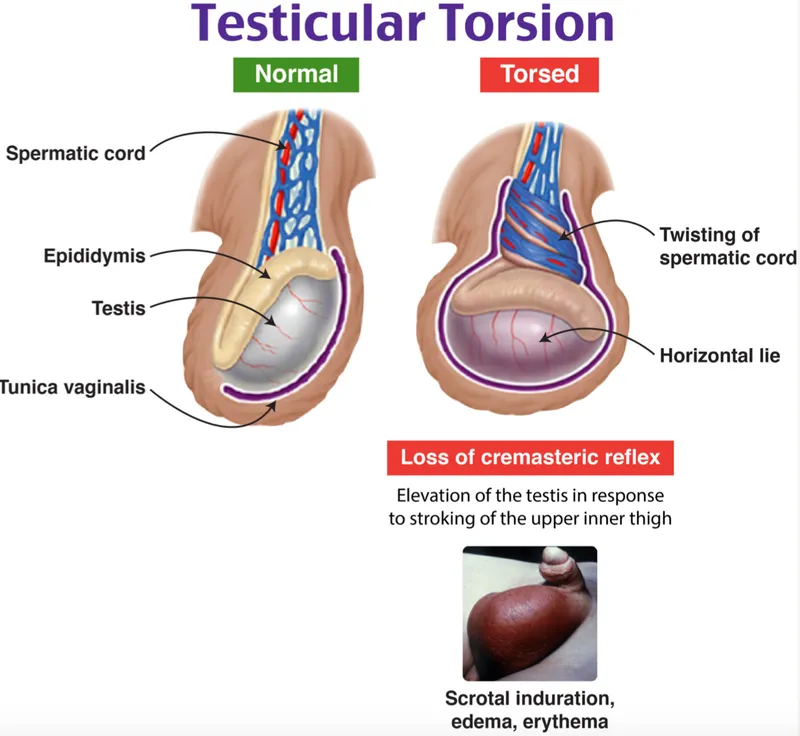 Testicular Torsion: Anatomy & Symptoms