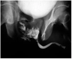 Retrograde urethrogram: posterior urethral extravasation